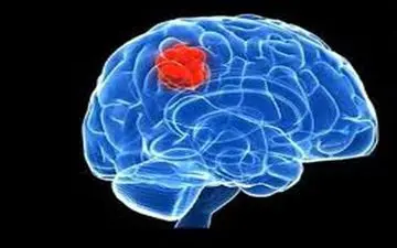  شایع‌ترین تومورهای مغزی تومورهای خوش خیم هستند 