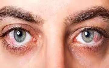 چطور تشخیص دهیم آب مروارید داریم؟