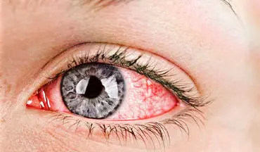 درمانی جدید برای التهاب چشم