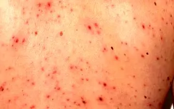 آیا می توان دوبار آبله مرغان گرفت؟ |علائم آبله مرغان در بزرگسالان