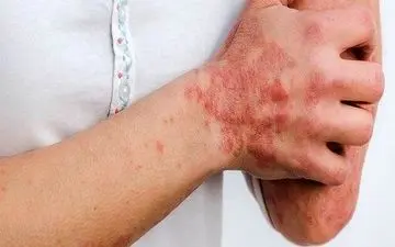 کرونا و مشکلاتی برای پوست