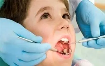 «فیشور سیلنت»، روشی مؤثر برای پیشگیری از پوسیدگی دندان کودکان