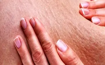 سلولیت چرا در زنان بیشتر است؟

