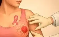 مراقب باشید| سرطان سینه را اینگونه کنترل کنید!