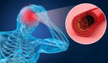 علائم غلظت خون چیست؟ |ارتباط بین غلظت خون و سابقه بیماری‌ها