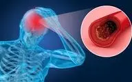 علائم غلظت خون چیست؟ |ارتباط بین غلظت خون و سابقه بیماری‌ها