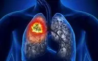 مصرف زیاد این ویتامین ابتلا به سرطان ریه در پی دارد!