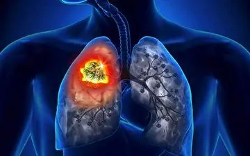 مصرف زیاد این ویتامین ابتلا به سرطان ریه در پی دارد!