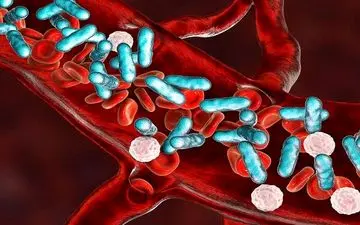 همه چیز درباره بیماری سپسیس