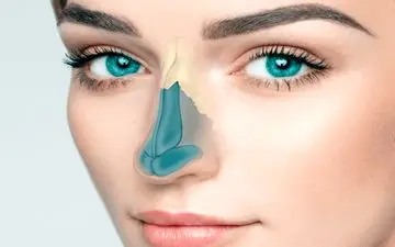 جراحی ترمیمی بینی کوتاه چگونه است؟