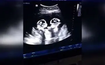  تصاویر سونوگرافی از دعوای دوقلوها در رحم مادر!