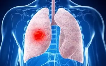 علائم بیماری ریوی را بشناسید