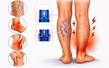 علائم اولیه واریس پا: نشانه‌هایی که باید جدی بگیرید