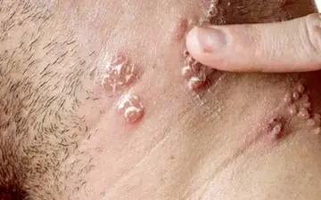 روش تشخیص بیماری زونا