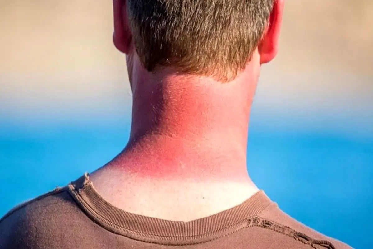 بهترین و موثرترین راهکارهای درمان آفتاب سوختگی