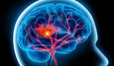 علائم تومور مغزی را بشناسید+ انواع