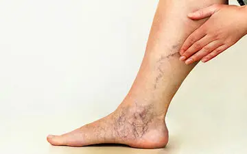 طرز تهیه درمان واریس با پماد فلفل| بیا بهت بگم پماد فلفل رو چطوری درست کنی!