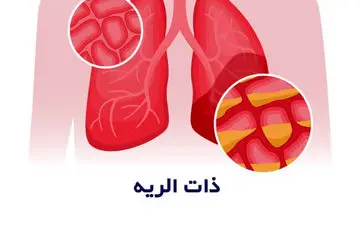 سینه پهلو یا ذات الریه چیست و چگونه ایجاد می­گردد؟