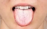 رنگ زبان سفید نشانه چیست؟