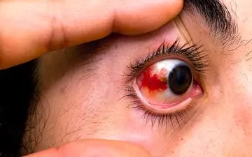 با پارگی رگ در چشم چه باید کرد؟ 
