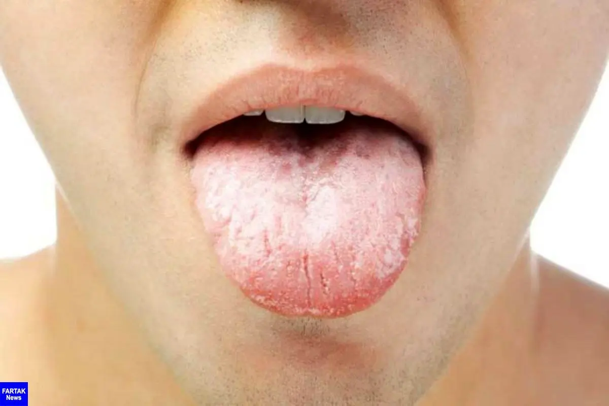 علت تلخی دهان چیست، درمان های خانگی تلخی دهان