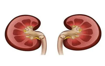 نشانه های سنگ کلیه کدامند؟