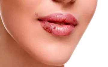 روش های  ساده و طبیعی برای درمان تبخال 