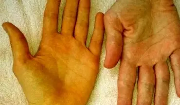 سفیدی چشم شما زرد است همین امروز به پزشک مراجعه کنید