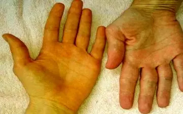 سفیدی چشم شما زرد است همین امروز به پزشک مراجعه کنید