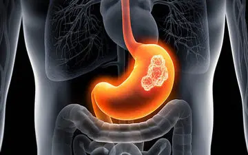 
درمان نکردن ورم معده خطرناک است