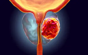 آشنایی با گیاهی برای سرکوب سرطان پروستات