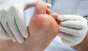 از چالش ها تا راهکارهای درمانی زخم پای دیابتی