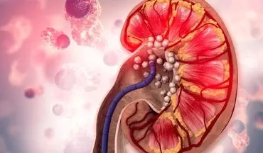 چگونه سلامت کلیه‌هایمان را تضمین کنیم؟