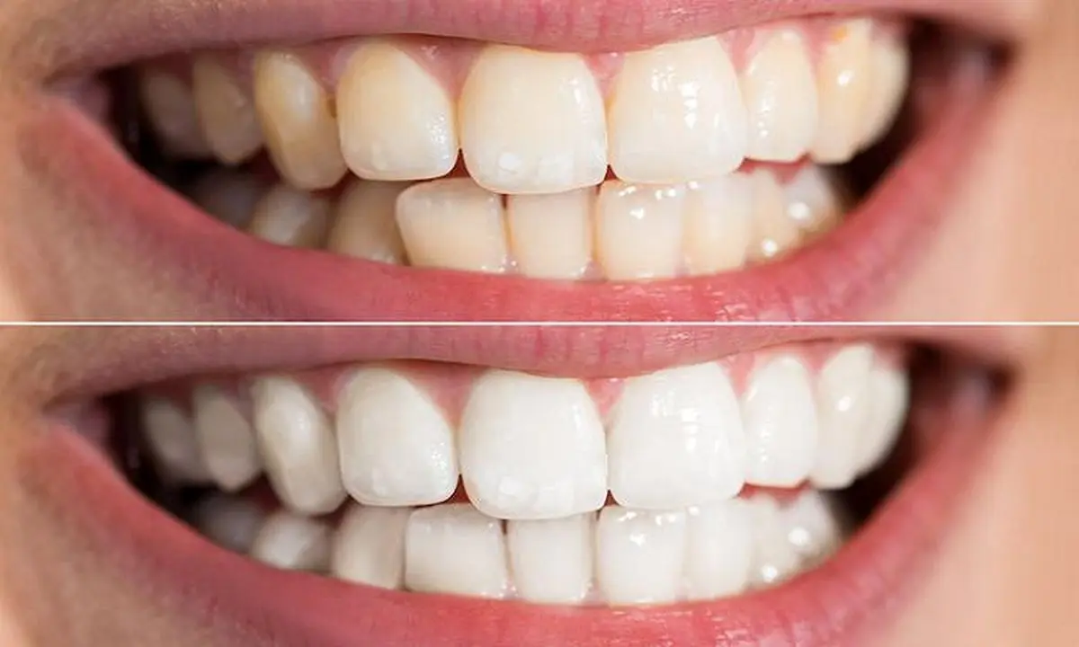 با این روش خانگی و ساده دندان‌هایتان را سفید کنید