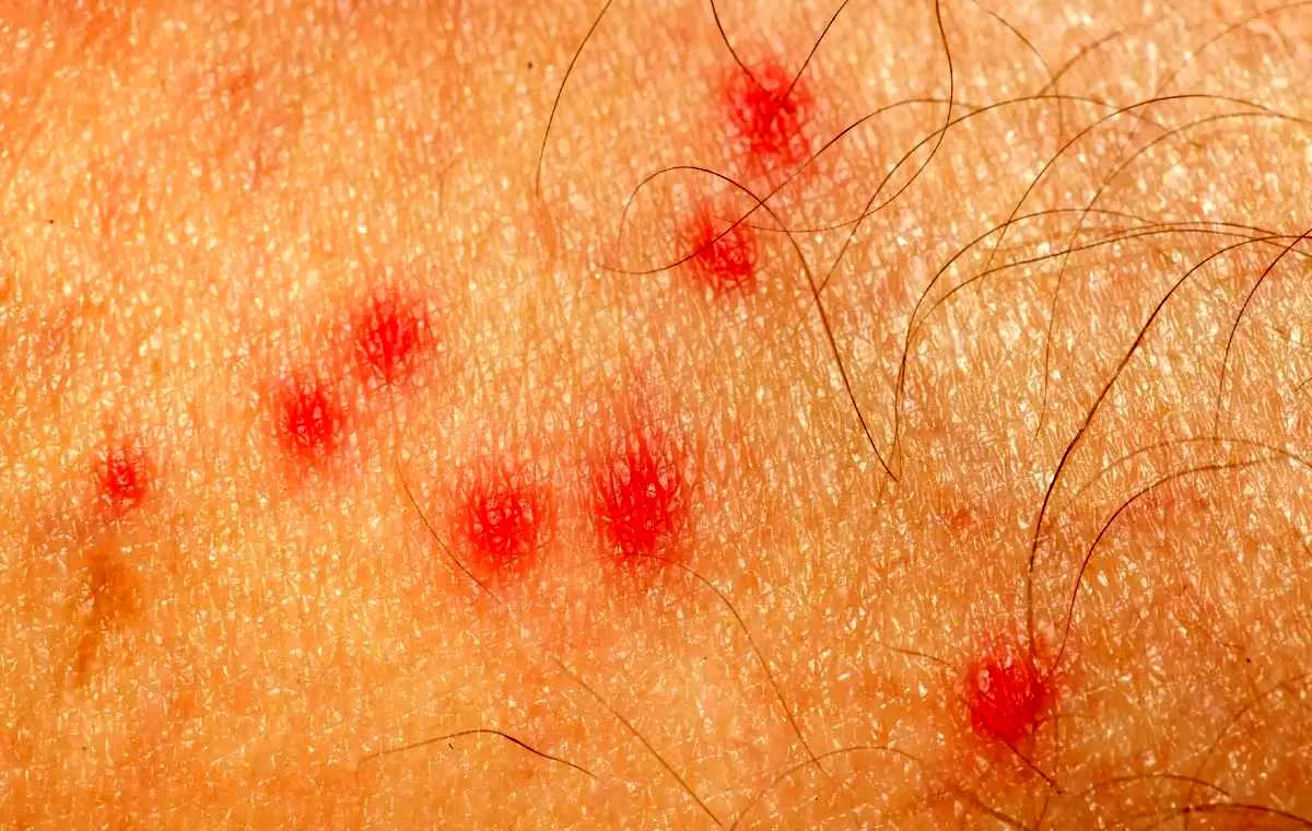   چه افرادی بیشتر در معرض نیش حشرات هستند؟ 