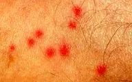 چه افرادی بیشتر در معرض نیش حشرات هستند؟