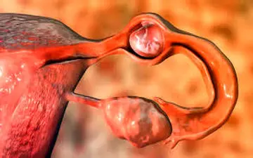 آیا این مورد عامل  سقط جنین  است؟