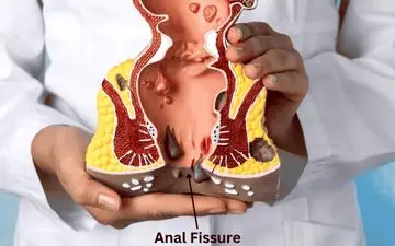 شقاق مقعدی چیست؟ علائم، علل و روش‌های درمان آن را بشناسید