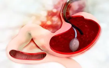 اختراعی جدید برای کمک به کاهش وزن؛ بالونی که پر و خالی می‌شود
