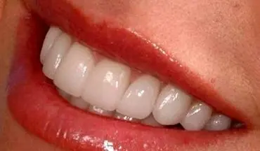 راه های  پیشگیری از خرابی دندان 
