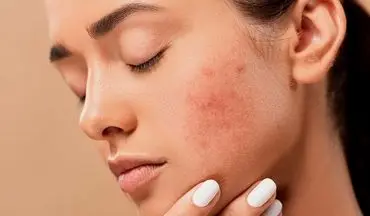 راه های از بین بردن  لک‌های پوستی !