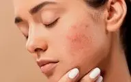 راه های از بین بردن  لک‌های پوستی !