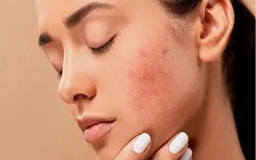 راه های از بین بردن  لک‌های پوستی !