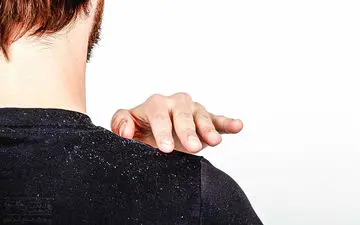 ۵ عامل اصلی شوره سر را بشناسید