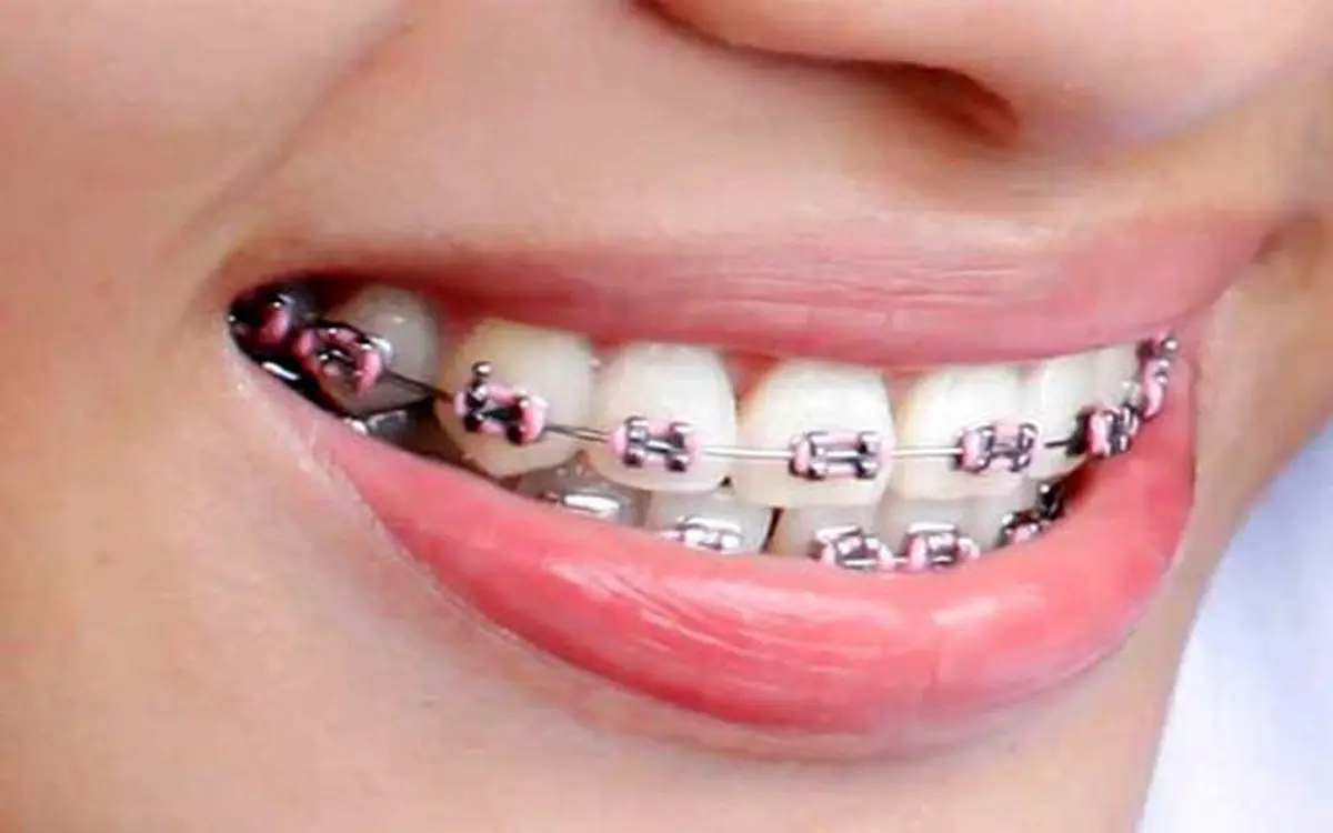 ارتودنسی موجب پوسیدگی دندان‌ها می‌شود؟