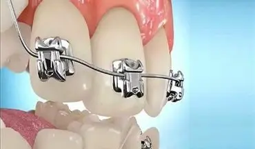 اصلاح عیوب دندان با کمک فناوری نانو در کشور