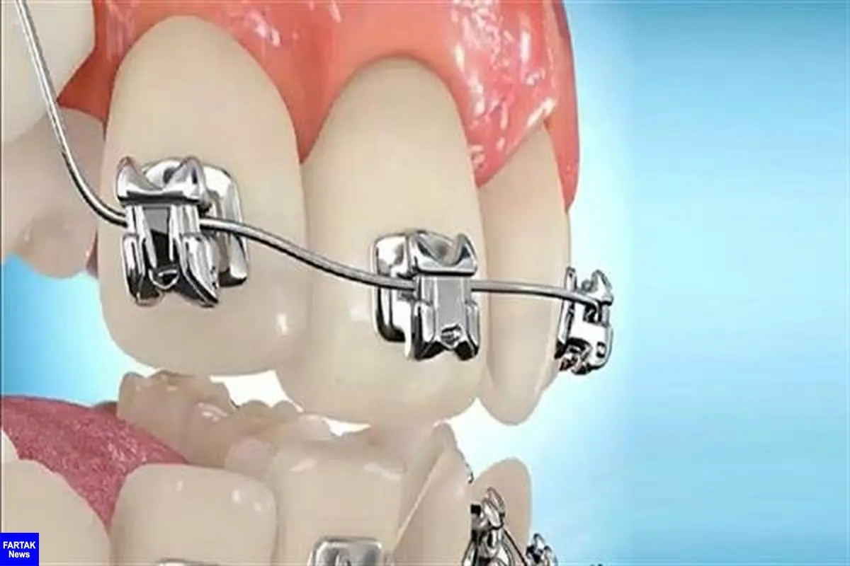 اصلاح عیوب دندان با کمک فناوری نانو در کشور