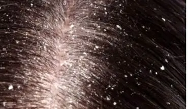 برای برطرف کردن مشکل شوره سر چکار کنیم؟