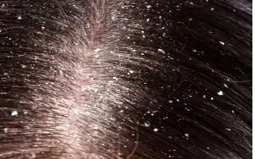 برای برطرف کردن مشکل شوره سر چکار کنیم؟