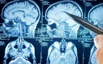 گلیوبلاستوما: تومور مغزی که مانند ریشه در مغز نفوذ می‌کند